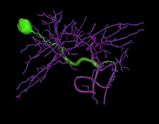 Foto: KI-gestützte Angiographie für präzisere Embolisation bei Leberkrebs...