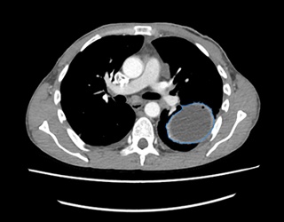 Foto: Vergütung für Lungenkrebs-Screening beschlossen...