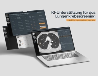 Foto: KI-Unterstützung für das Lungenkrebsscreening...