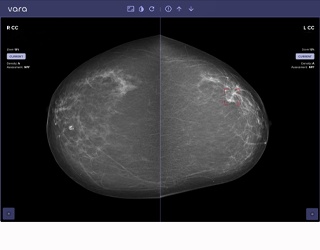 Pünktlich zum Brustkrebsmonat Oktober: Radiologische Allianz setzt künstliche Intelligenz bei der Erkennung von Brustkrebs ein